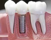 Лечение зубов и имплантация. лечение тяжелых случаев кариеса.